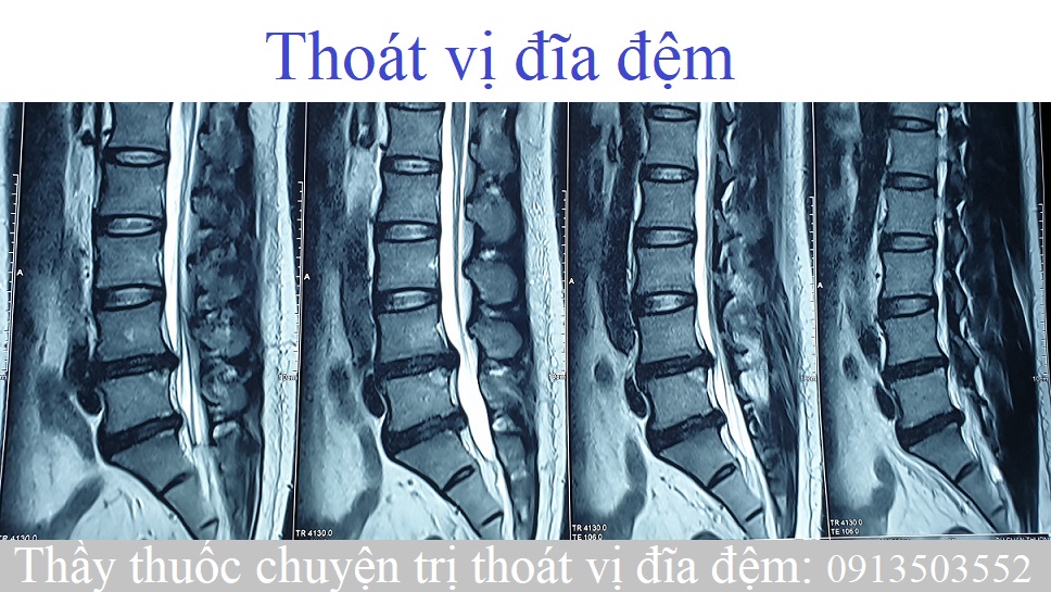 Cách phát hiện bệnh thoát vị đĩa đệm, lồi đĩa đệm